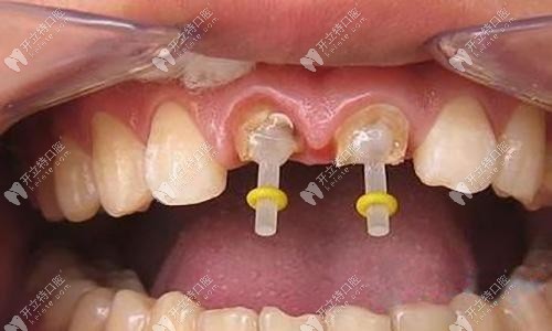 纖維樁的外觀(guān)