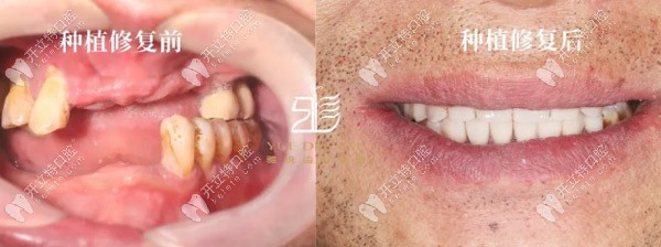 梁先生種植修復(fù)前后對比 梁先生種植修復(fù)前后對比