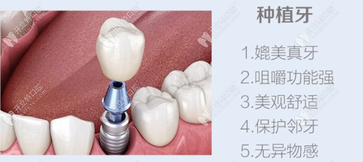 種植牙的優(yōu)勢(shì)