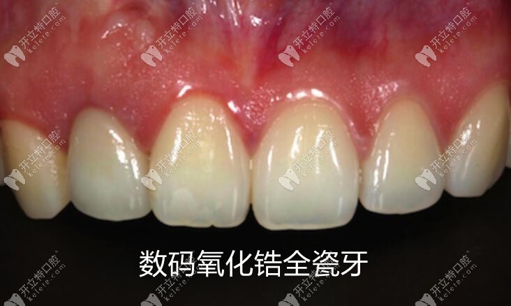 比起數(shù)碼二氧化鋯牙與全瓷牙哪個好?我也饞它們的價格