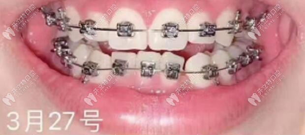 戴美國3M托槽矯正齙牙4個月的效果