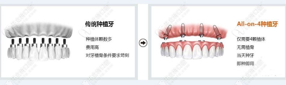 傳統(tǒng)種植牙和all on 4種植牙對(duì)比 傳統(tǒng)種植牙和all on 4種植牙對(duì)比