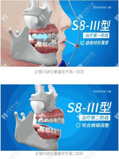 正雅S8、S9、S10頜位重建術(shù)