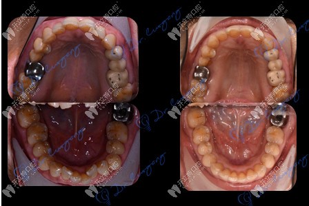 牙齒矯正前后對比