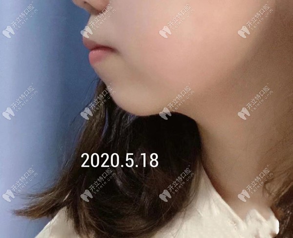 重慶華美口腔丁愛軍醫(yī)生矯正骨性齙牙嘴凸效果怎么樣？