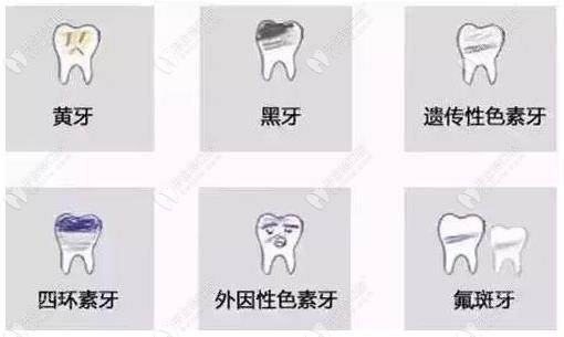 適合做皓齒美白的牙齒情況