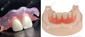 隱形假牙