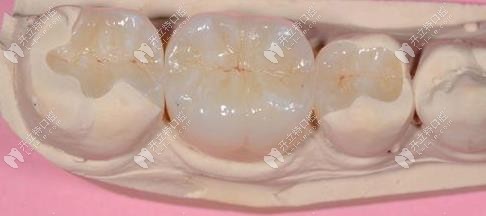 樹脂補牙外觀圖