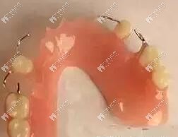 彎制不銹鋼掛鉤假牙