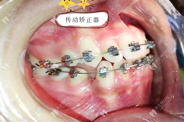 傳動(dòng)矯正器在口內(nèi)的展示圖