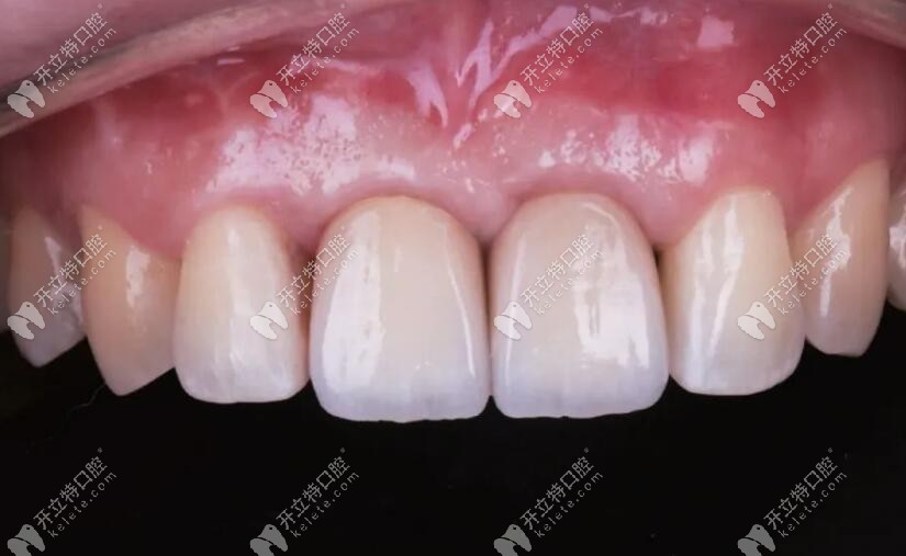 整個(gè)修復(fù)病例完成后的情況